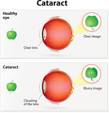 recovery after cataract surgery