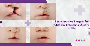 reconstructive surgery for cleft lip