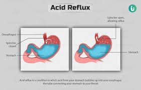acid reflux symptoms causes