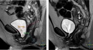 pelvic organ prolapse