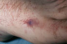 aplastic anemia rash types treatment