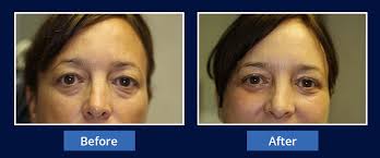 cosmetic laser eye surgery fairfax