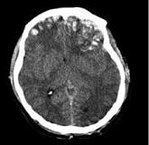 Image result for icd 10 code for focal hemorrhagic contusion of cerebrum