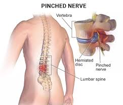 5 common symptoms of a pinched nerve