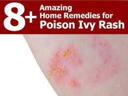 home remes for poison ivy rash