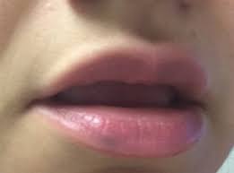 i have a venous lake on my lip and am