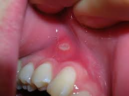 cold sores and canker sores