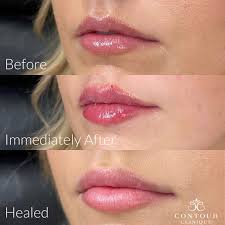 the lip filler swelling ses a day