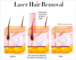 Electrolysis Vs Laser Hair Removal The Complete Guide