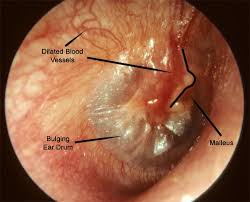 Middle Ear Infection Images Mcgovern Medical School