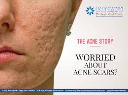 dermal fillers for acne scars treatment