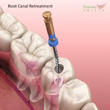 root c retreatment best smiles dental