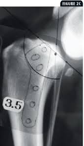 Understanding Tibial Plateau Leveling Osteotomies In Dogs