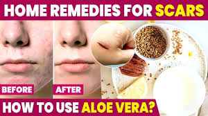 scar removal home remes skin care