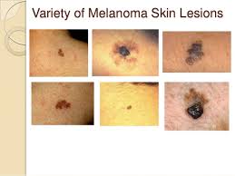 Resultado de imagen para melanoma