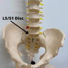 herniated disc l5 s1 causes symptoms
