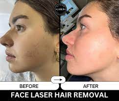 laser hair removal all in one laser