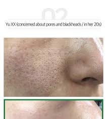 The acidulous cleanser exfoliates the. Some By Mi Bye Bye Blackhead 30 Days Miracle Green Tea Tox Bubble Cleanser Hermo