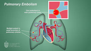 In most cases, the embolism is caused by blood thrombi, which arise from the. Pe Pulmonary Embolism St Vincent S Lung Health