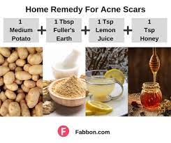 home remes for acne scars