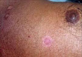 photograph of skin lesions showing disc