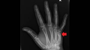 broken knuckle on finger symptoms