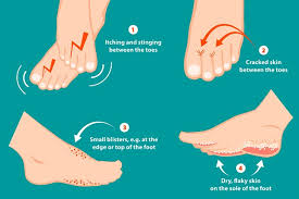 fungal infection of the foot