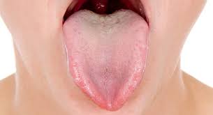 Haptō, deutsch ‚entfachen') ist eine schmerzhafte, von einem entzündlichen randsaum umgebene schädigung der schleimhaut des zahnfleischs, der mundhöhle einschließlich der lippen, der tonsillen oder der zunge. Aphten Auf Der Zunge Online Arztedienst Dokteronline Com
