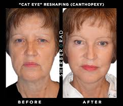 If you need cataract surgery in both eyes, your surgeon usually will wait at least a few days to two weeks for your first eye to recover before performing a procedure on the second eye. Cat Eye Reshaping Washington Dc Canthopexy Northern Va