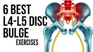 6 best l4 l5 disc bulge exercises in