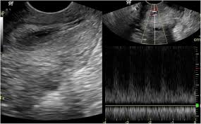 role of transinal ultrasound in