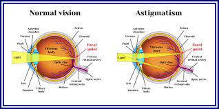 lasik for astigmatism success rates