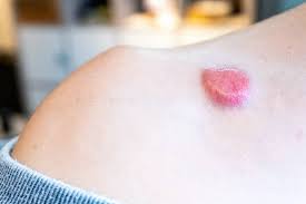how to spot non melanoma skin cancers