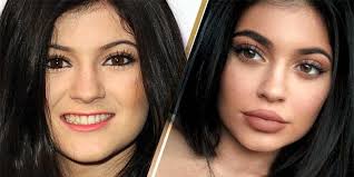 kylie jenner gets her lips done