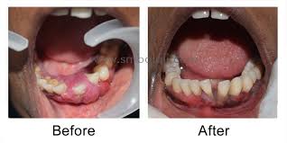 health for induced swollen gums