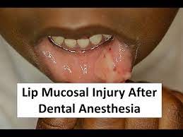 lip mucosal trauma after dental