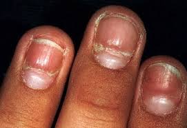 milady nail disorders and disease