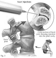 facet joint injections north bristol