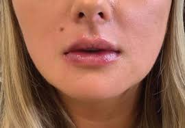 how long do lip fillers last how to