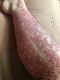 The rash may also be itchy. Iga Vasculitis Niddk