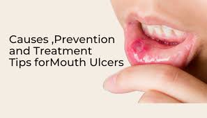 mouth ulcers tips causes prevention