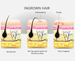 ingrown hair causes prevention