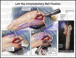 left hip intramedullary nail fixation
