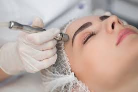 microdermabrasion treatment barrie