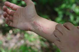how to treat a poison ivy rash at home