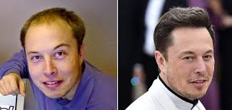 elon musk hair transplant and other