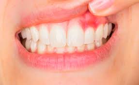 bleeding gums reasons and ways to treat it