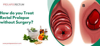 rectal prolapse treatment by herbal