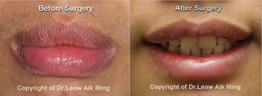 aesthetic surgery for lips