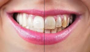 For some, smoking and chewing tobacco products over the years leads to staining. Ask A Dentist About How To Get Stains Out Of Your Teeth